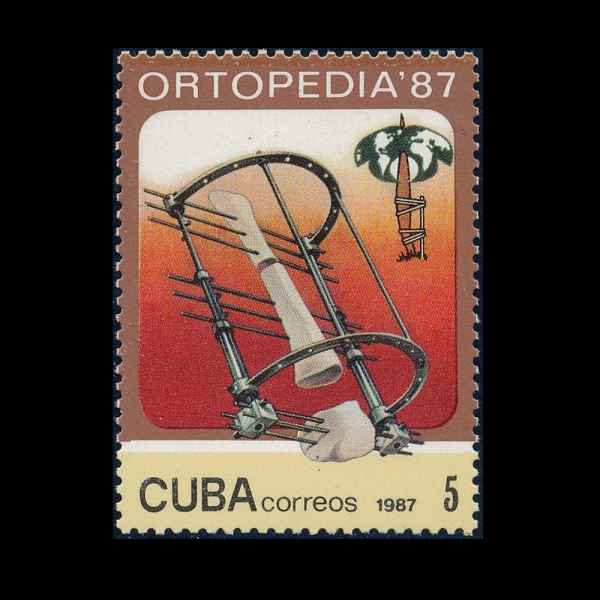 CUBA()-#2944-5c-BONE-LENGTHENING PROCEDURE(  )-1987.5.4